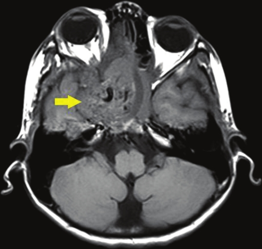 Axial section, T1-weighted magnetic resonance image shows a large, well-defined mass (arrow) in the region of the pterygo-maxillary fissure and sphenopalatine foramen on the right side with a heterogenous intensity.